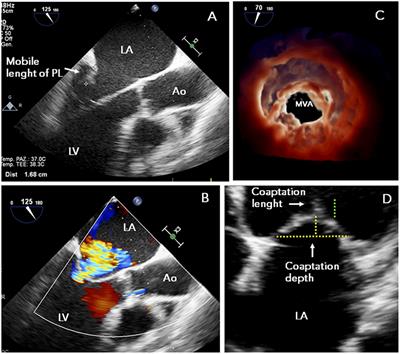 Selection of the Optimal Candidate to MitraClip for Secondary Mitral Regurgitation: Beyond Mitral Valve Morphology